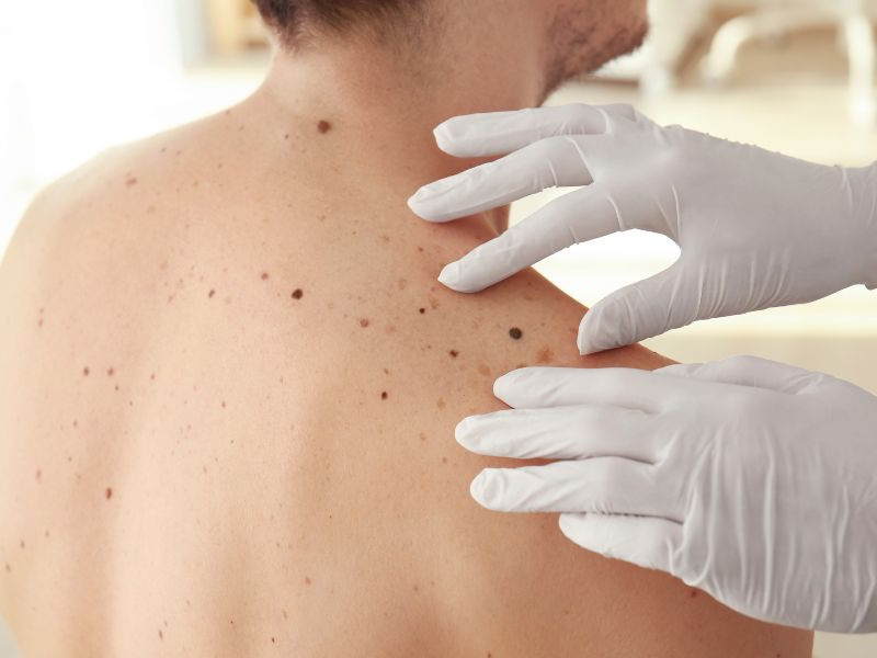 Dermatolog vam lahko pomaga pri težavah s kožo